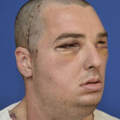 Weltweit umfangreichste Gesichtstransplantation