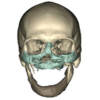 Weltweit umfangreichste Gesichtstransplantation
