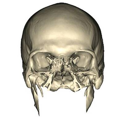 Weltweit umfangreichste Gesichtstransplantation