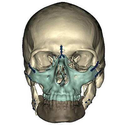 Weltweit umfangreichste Gesichtstransplantation