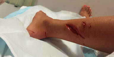 Surferin (13) überlebt Hai-Attacke 