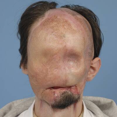 Ein Stromschlag verstümmelte den Amerikaner Dallas Wiens