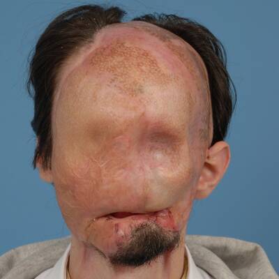 Ein Stromschlag verstümmelte den Amerikaner Dallas Wiens