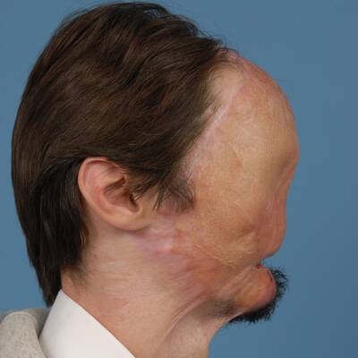 Ein Stromschlag verstümmelte den Amerikaner Dallas Wiens