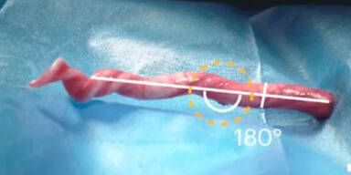 Penis-Prothese aus dem 3D-Drucker