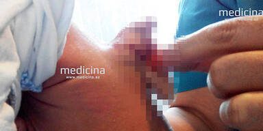 Baby mit Extra-Penis am R&uuml;cken geboren