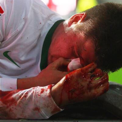 Prödl schwer am Kopf verletzt