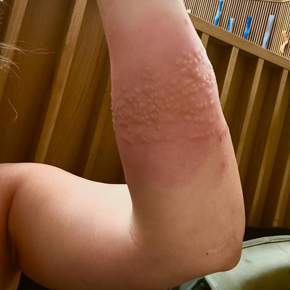 Giftige-Qualle! Badegast landet mit verbranntem Arm im Spital