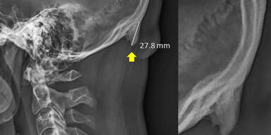 W&auml;chst dir auch so ein Knochen am Hinterkopf?