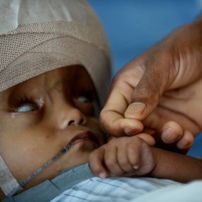 Mädchen mit Wasserkopf operiert