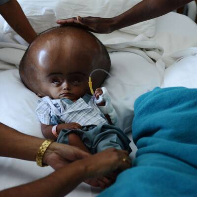 Mädchen mit Wasserkopf operiert