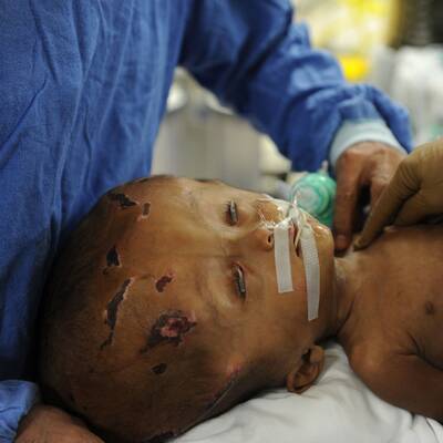 Mädchen mit Wasserkopf operiert