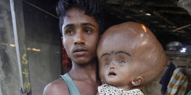 Kleines Mädchen hat riesigen Wasserkopf