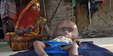 Kleines Mädchen hat riesigen Wasserkopf