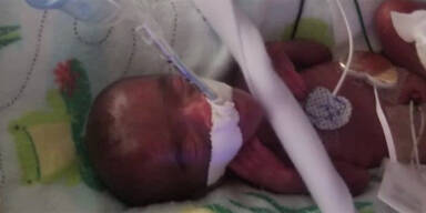 Das ist das kleinste Baby der Welt