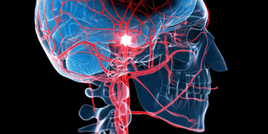 Rezept f&uuml;r einen Schlaganfall?