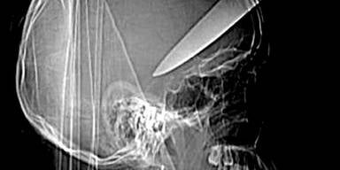 Diebe rammten Teenager Messer in den Kopf