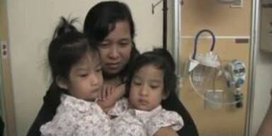 Ärzte trennen siamesische Zwillinge