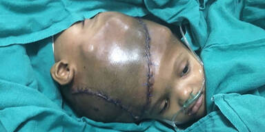 Siamesische Zwillinge nach Marathon-OP getrennt