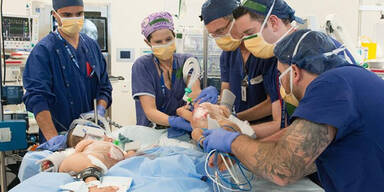 Siamesische Zwillinge erfolgreich getrennt