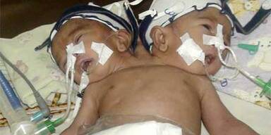 siamesische_zwillinge