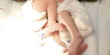 siamesische_zwillinge