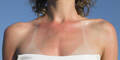 Sonnenbrand
