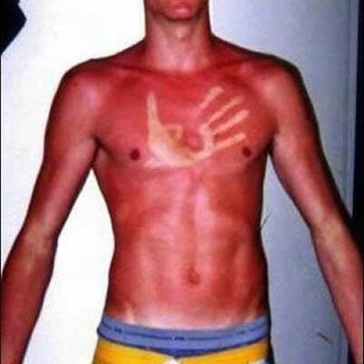 Lustige Sonnenbrände