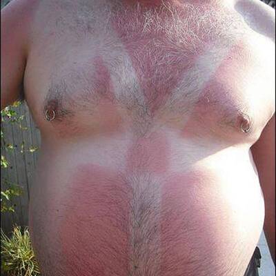 Lustige Sonnenbrände