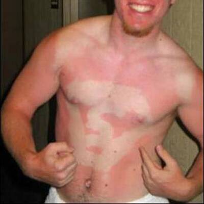 Lustige Sonnenbrände