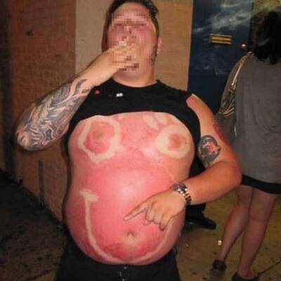 Lustige Sonnenbrände