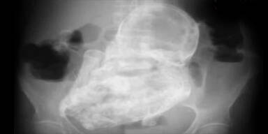 &Auml;rzte finden 40 Jahre alten F&ouml;tus in Frau