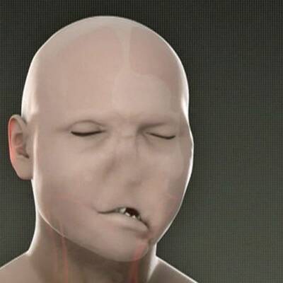 Erste Gesichtstransplantation