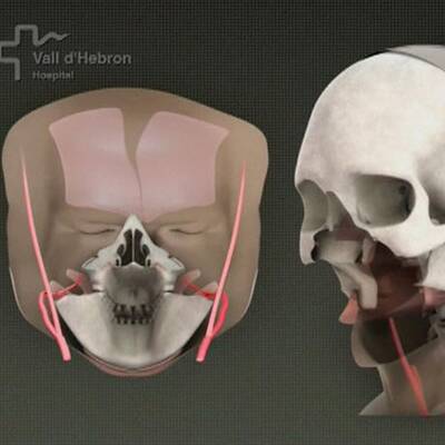 Erste Gesichtstransplantation