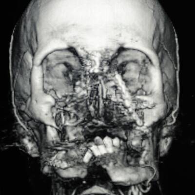 Erste Gesichtstransplantation