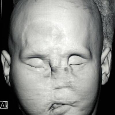 Erste Gesichtstransplantation