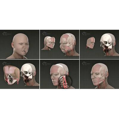 Erste Gesichtstransplantation