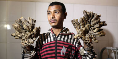 "Baummann" will sich H&auml;nde amputieren lassen