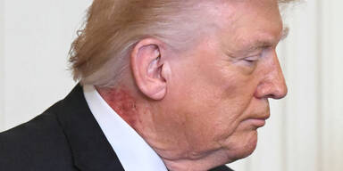Ausschlag an Trumps Hals