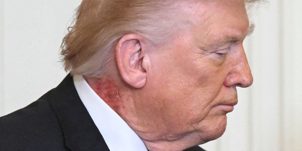 Ausschlag an Trumps Hals