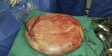 Riesen-Tumor bei Frau entfernt