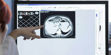 Graz: Ärzte entfernten kiloschweren Tumor