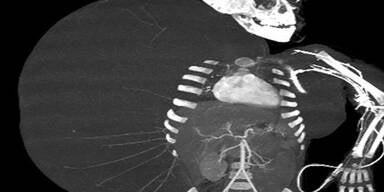 Bub hatte Tumor, der größer war, als er