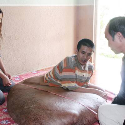 31-Jähriger hat 80-Kilo-Tumor