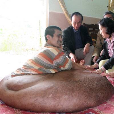 31-Jähriger hat 80-Kilo-Tumor