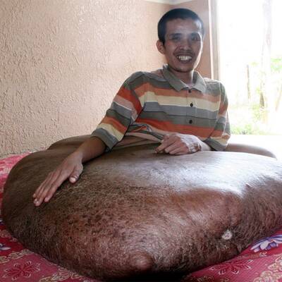 31-Jähriger hat 80-Kilo-Tumor