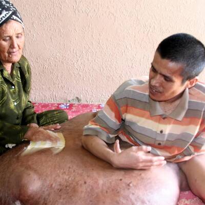 31-Jähriger hat 80-Kilo-Tumor