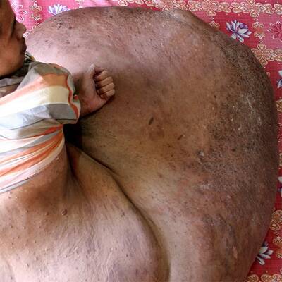 31-Jähriger hat 80-Kilo-Tumor