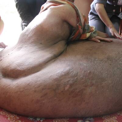 31-Jähriger hat 80-Kilo-Tumor