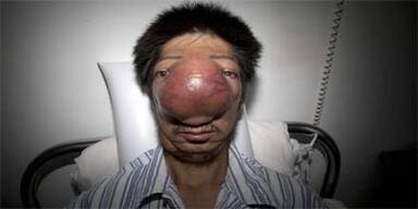 Chinese durch Riesen-Tumor entstellt